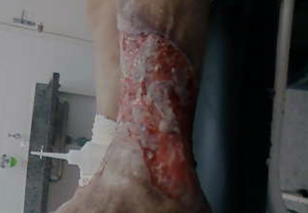 Antes
