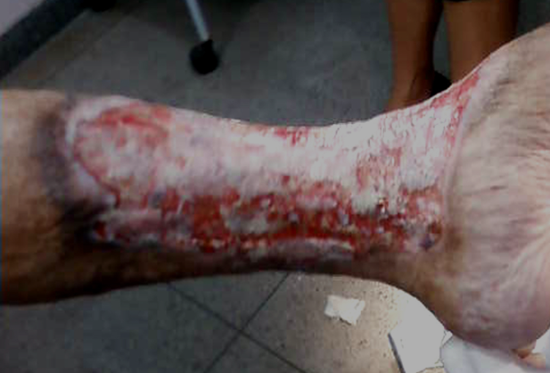 Antes