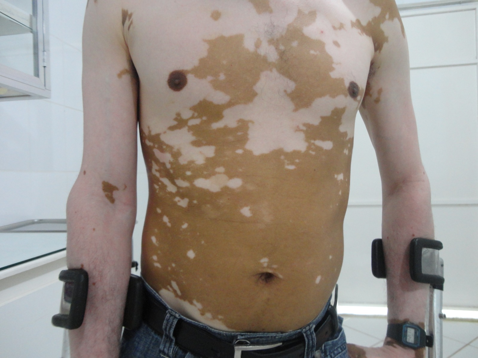 Vitiligo
